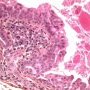 Hidrocystoma
