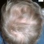 Griscelli syndrome - Hair