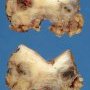Granulation tissue beside a pilonidal cyst