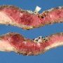 Placenta percreta