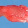 Hand edema