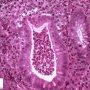Cryptic abcess in active Crohn colitis