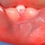 Caudal regression syndrome with lombosacral agenesis