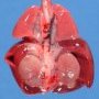 Bilateral renal agenesis in a fetus