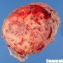 Massive placental fibrosis