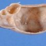 Ovarian cystic juvenile granulosa tumor