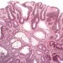 Tubulous microadenoma in FAP