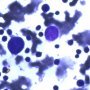 Parvovirus B19 cytopathogenic effect in bone marrow