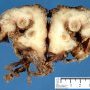 Periappendicular abcess in acute appendicitis
