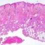 Dermatofibrosarcoma protuberans