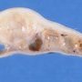 Ovarian cystic juvenile granulosa tumor