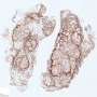 Lobular capillary hemangioma