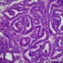 Wilms tumor. Epithelial component