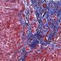 Portal fibrosis and biliary ductular proliferation in juvenile (...)
