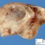 Tubal ectopic pregnancy