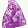 Pulmonary perivascular lymphoplasmocytic infiltrate and perivascular (...)