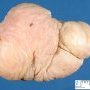 Lower limb lipoma