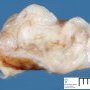 Mediastinal esophageal duplication cyst (primitive foregut cyst)