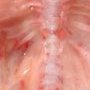D12-L2 vertebral hypoplasia