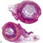 Acute appendicitis
