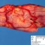 Cellular schwannoma