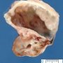 Fetal hydronephrosis with polar cystic dilatation