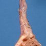 Paratesticular hematoma