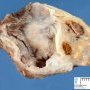 Ovarian serous cystadenoma