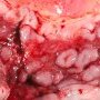 Crohn ileitis and colitis (ileocaecal region)
