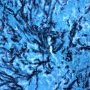 Invasive pulmonary aspergillosis