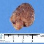 Colonic juvenile polyp