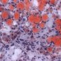 Macrovesicular hepatocytic steatosis (Oil-Red-O)