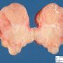 Mammary fibroadenoma