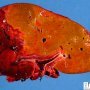 Hepatic ischemia in a liver allograft