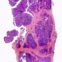 Thymic seminoma