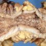 Cobblestone appearance in Crohn ileitis