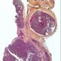 Tumoral thrombosis of the renal vein (suprarenal neuroblastoma)