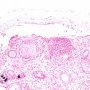 Renal tubular calcifications
