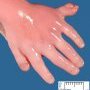 Hand post-axial polydactyly in Smith-Lemli-Opitz syndrome