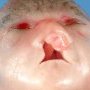 Bilateral cleft lip/palate, omphalocele, postaxial polydactyly in trisomy (...)
