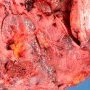 Placenta percreta