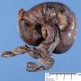 Intestinal intussuspection and infarction on Meckel diverticula