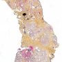 Lobular capillary hemangioma