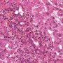 Acute cholangitis