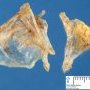 Ovarian cystic juvenile granulosa tumor