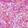 Cardiac rhabdomyoma