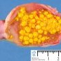 Biliary lithiasis (Cholelithiasis)