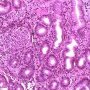 Gastric acute glandulitis and glandular abcess