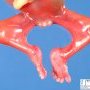 Caudal regression syndrome with lombosacral agenesis