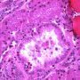 Foamy macrophages in renal tubules
